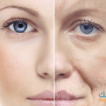 علاج التجاعيد المُبكرة في الوجه وتحت العينين ووصفات طبية للوقاية من التجاعيد