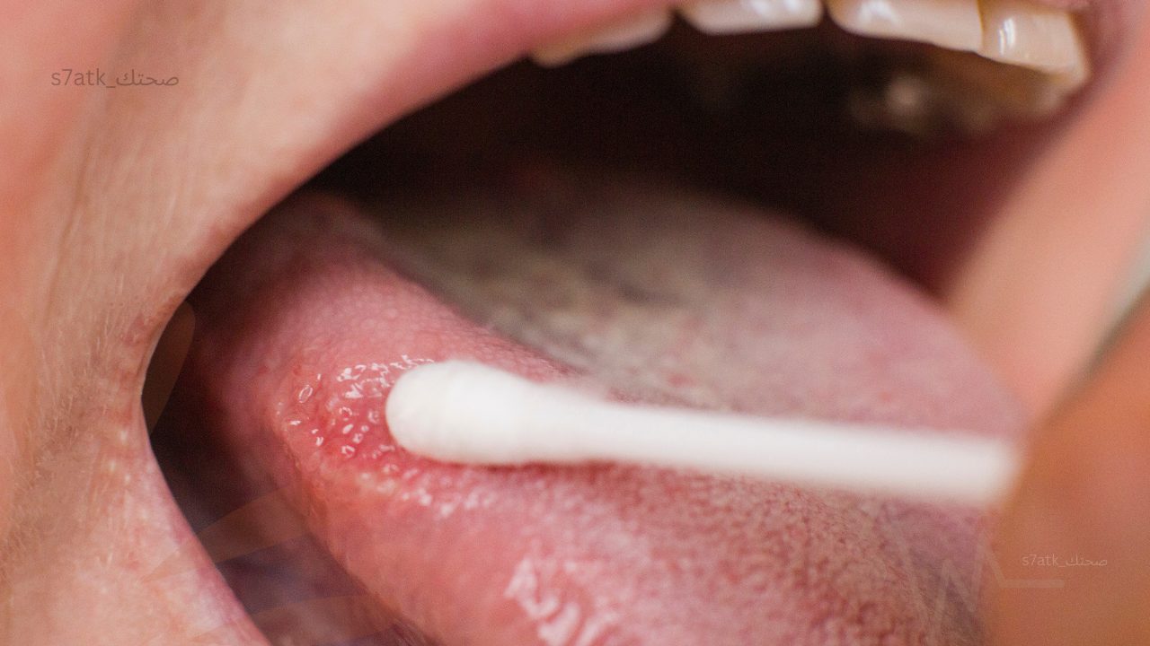 أعراض تقرحات الفم عند الأطفال